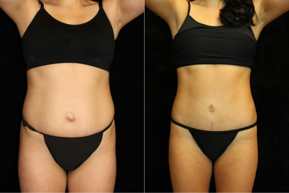 Liposuction Before & After Gallery - Patient 278768 - Image 1