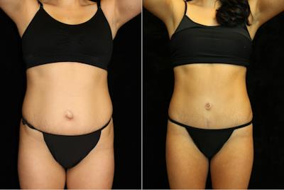 Liposuction Before & After Gallery - Patient 278768 - Image 1