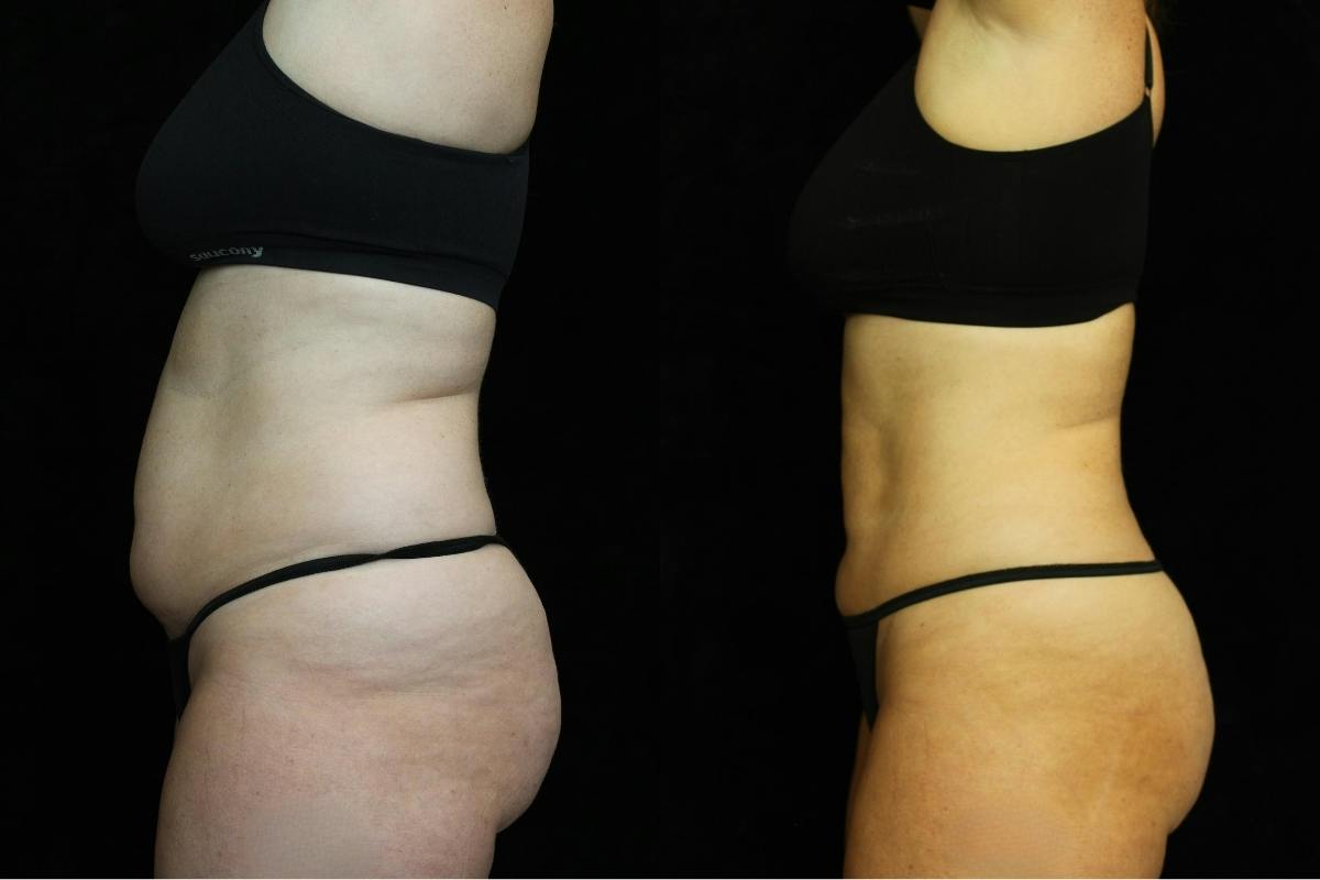Liposuction Before & After Gallery - Patient 278768 - Image 3