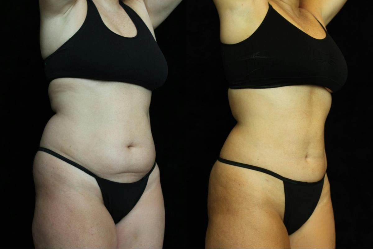Liposuction Before & After Gallery - Patient 409066 - Image 2