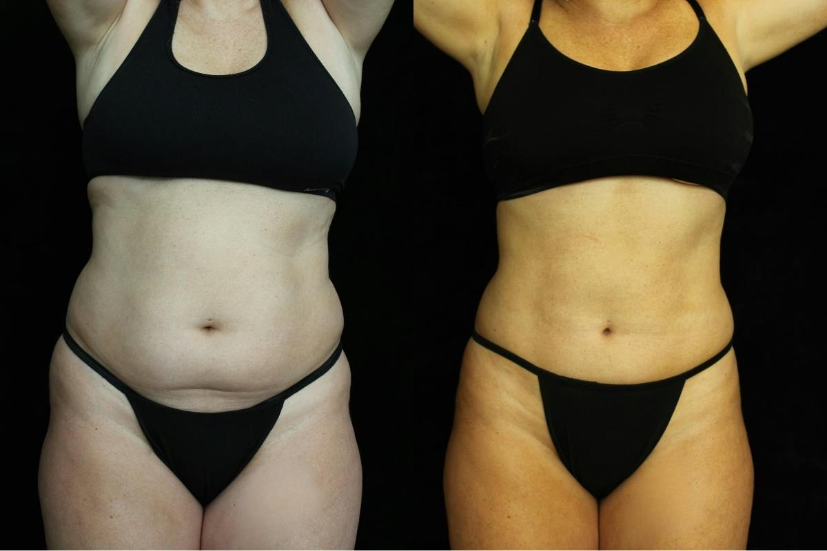 Liposuction Before & After Gallery - Patient 409066 - Image 1