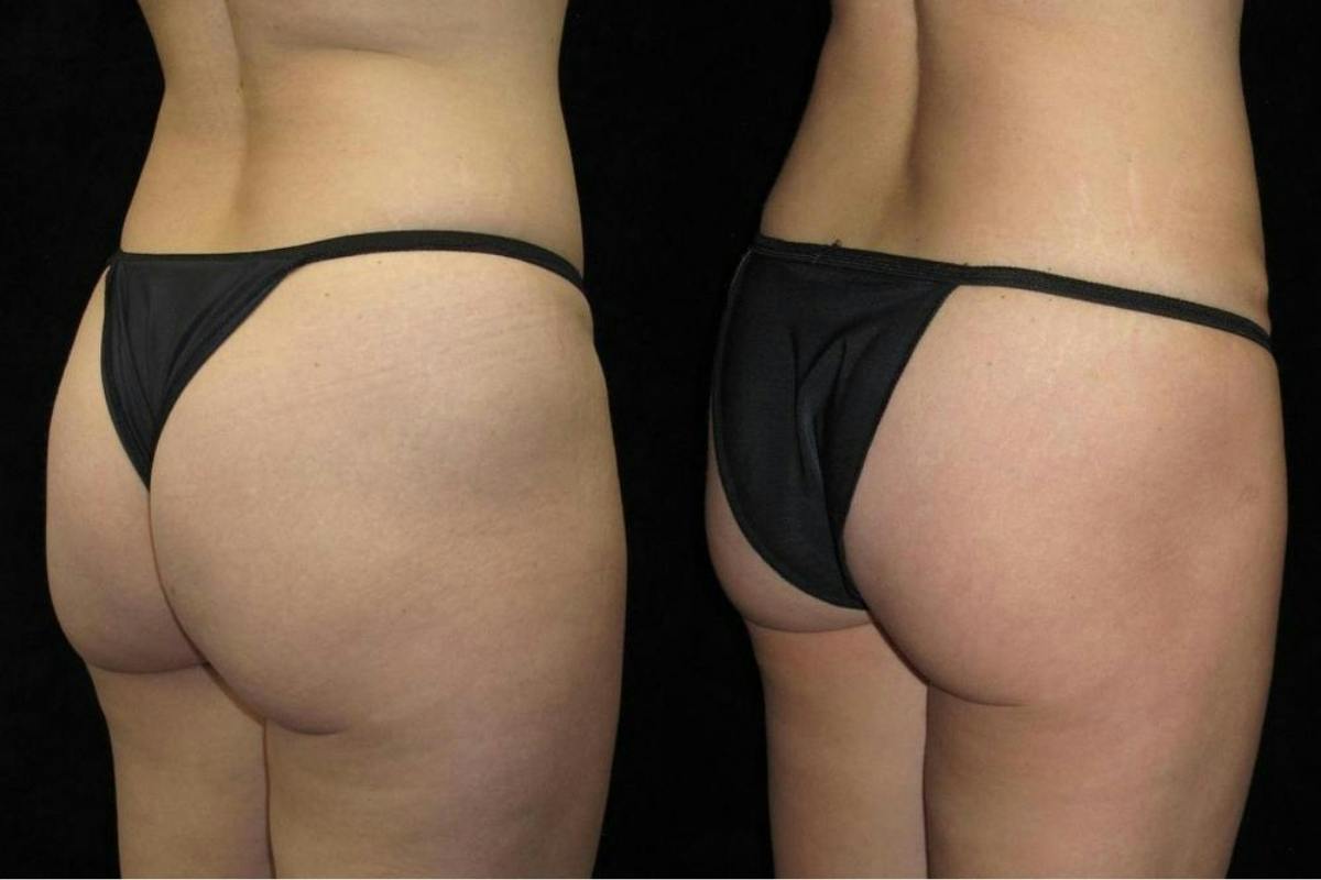 Liposuction Before & After Gallery - Patient 799090 - Image 1