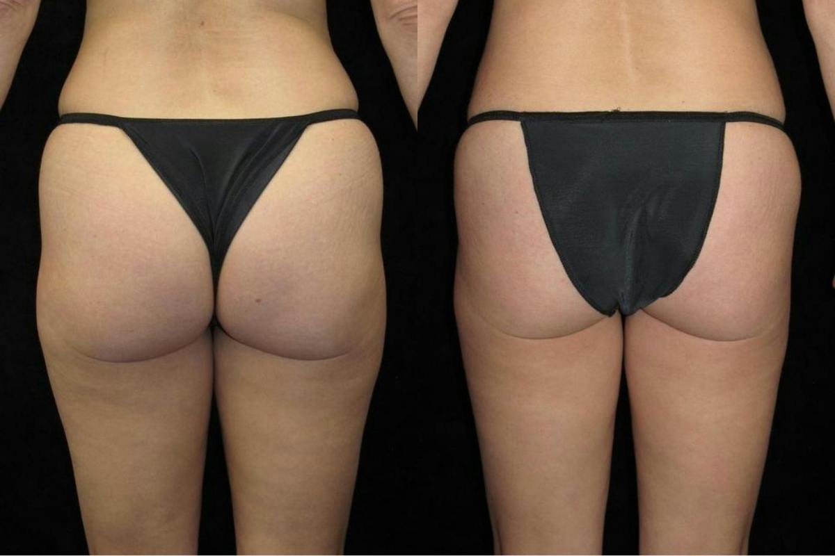 Liposuction Before & After Gallery - Patient 799090 - Image 2