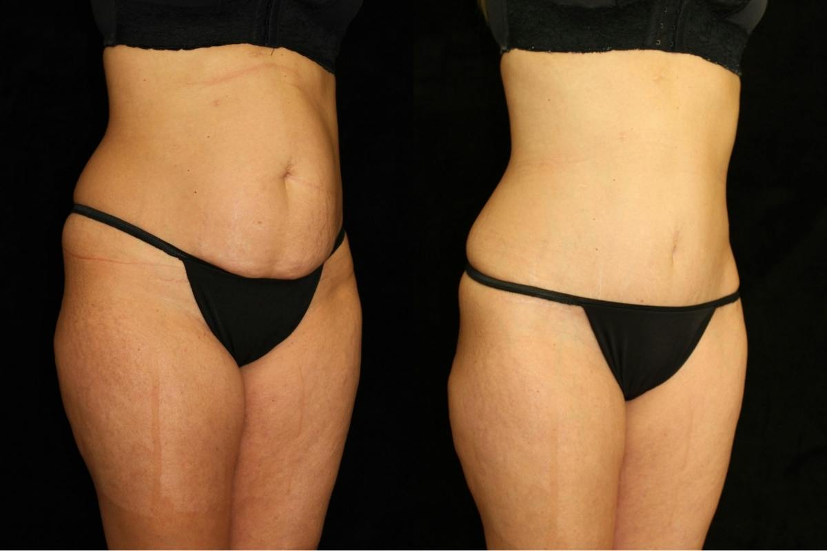 Liposuction Before & After Gallery - Patient 656522 - Image 2