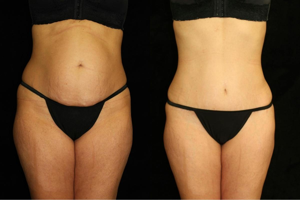 Liposuction Before & After Gallery - Patient 656522 - Image 1