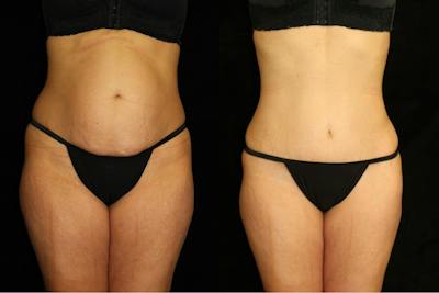 Liposuction Before & After Gallery - Patient 656522 - Image 1