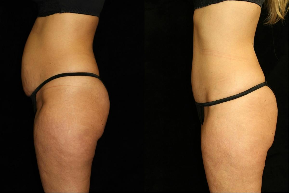 Liposuction Before & After Gallery - Patient 656522 - Image 3