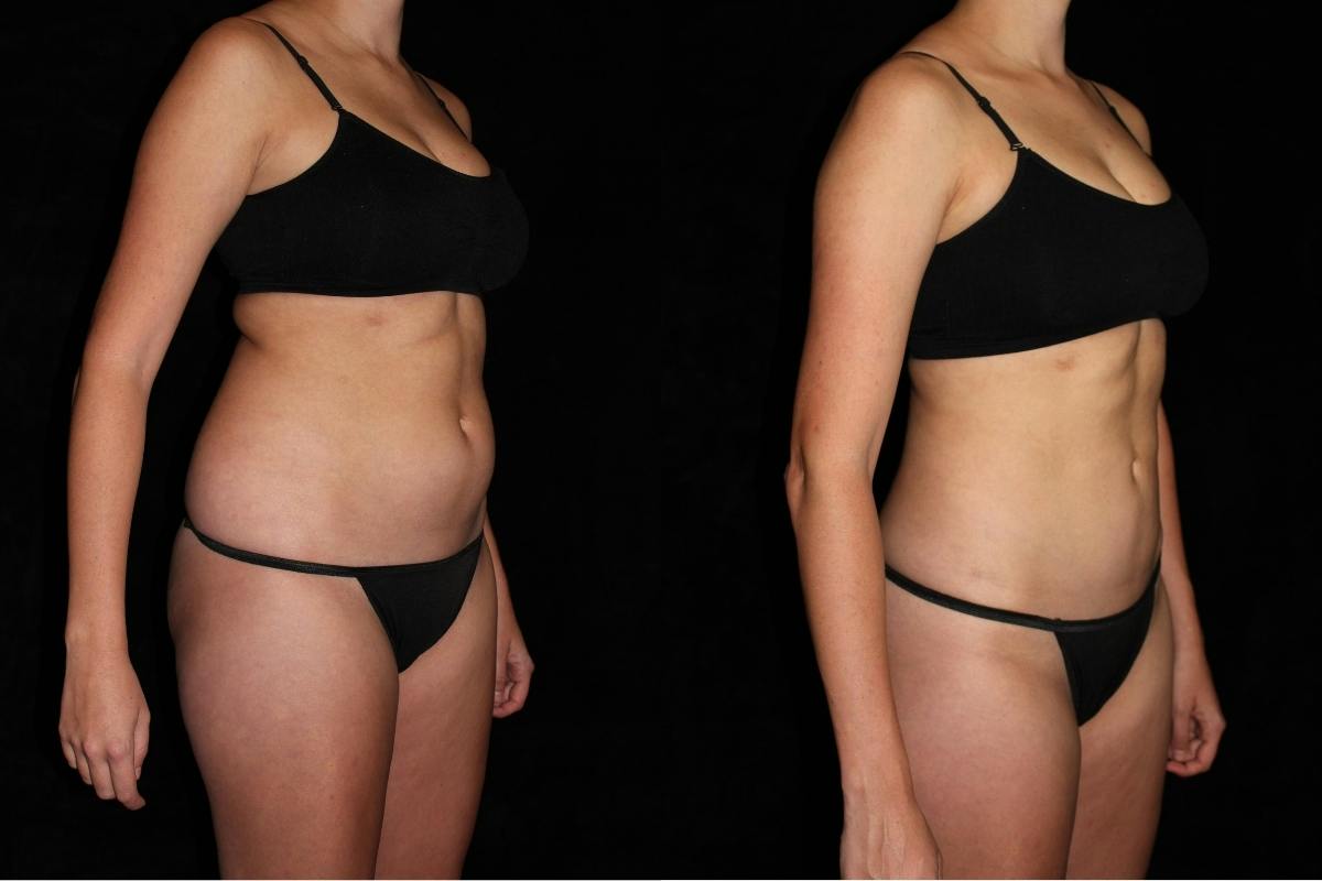 Liposuction Before & After Gallery - Patient 374839 - Image 2