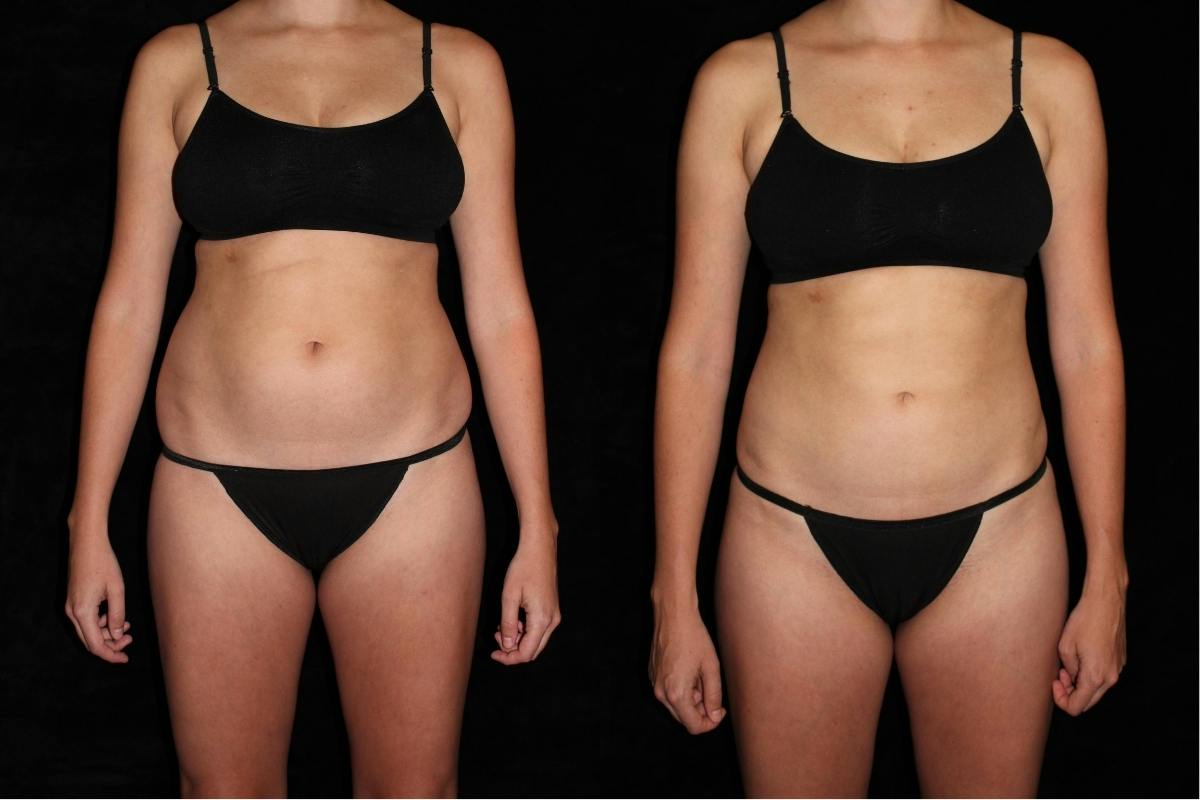 Liposuction Before & After Gallery - Patient 374839 - Image 1
