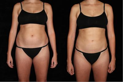 Liposuction Before & After Gallery - Patient 374839 - Image 1