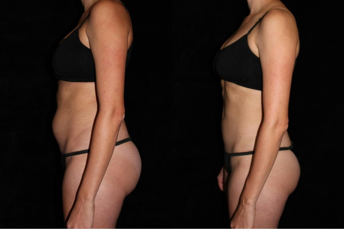 Liposuction Before & After Gallery - Patient 374839 - Image 3