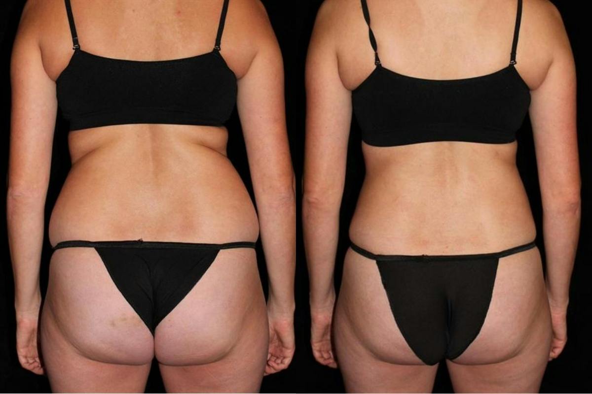 Liposuction Before & After Gallery - Patient 235112 - Image 4