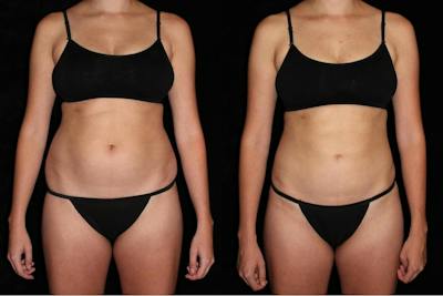 Liposuction Before & After Gallery - Patient 235112 - Image 1