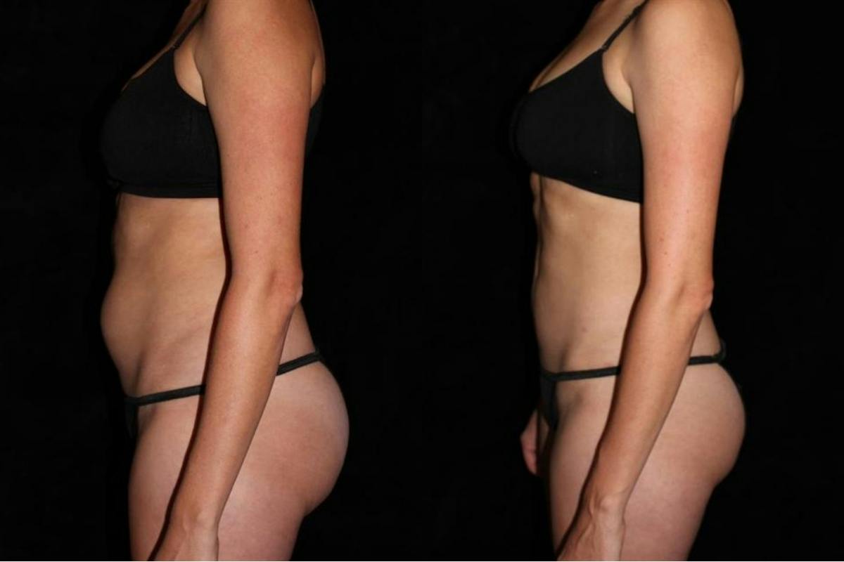 Liposuction Before & After Gallery - Patient 235112 - Image 3