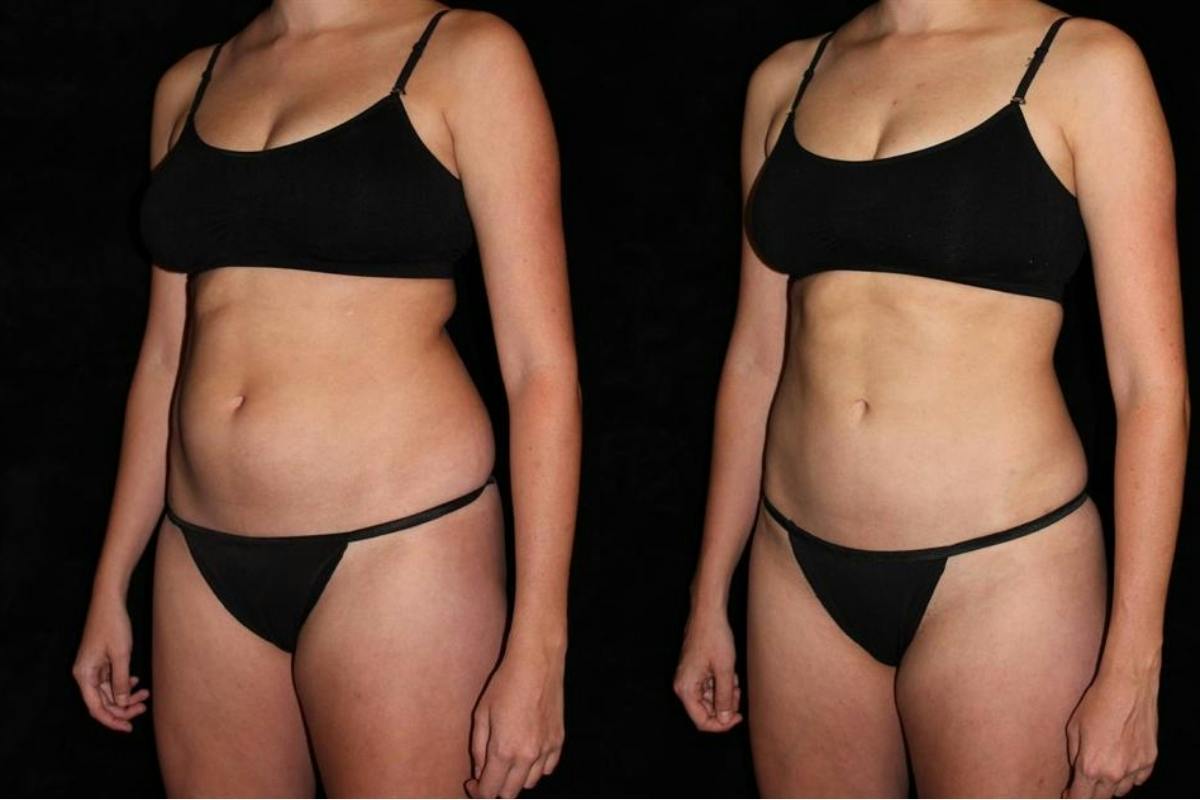 Liposuction Before & After Gallery - Patient 235112 - Image 2