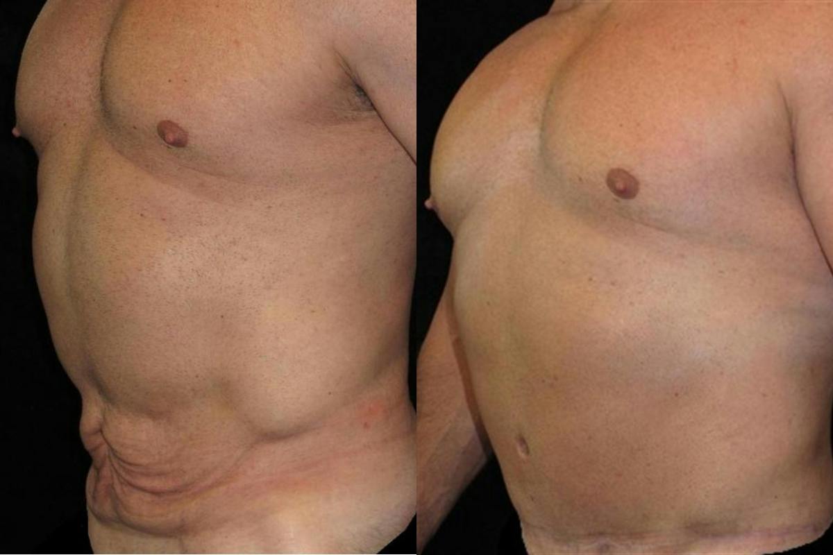 Male Body Contouring Before & After Gallery - Patient 189697 - Image 2