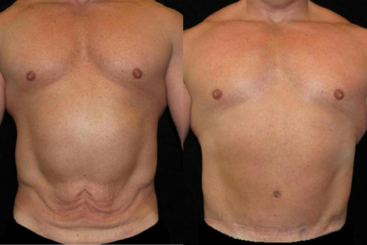 Male Body Contouring Before & After Gallery - Patient 189697 - Image 1