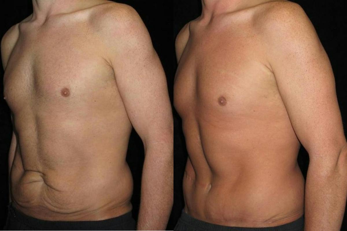 Male Body Contouring Before & After Gallery - Patient 372244 - Image 2