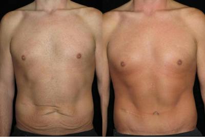 Male Body Contouring Before & After Gallery - Patient 372244 - Image 1