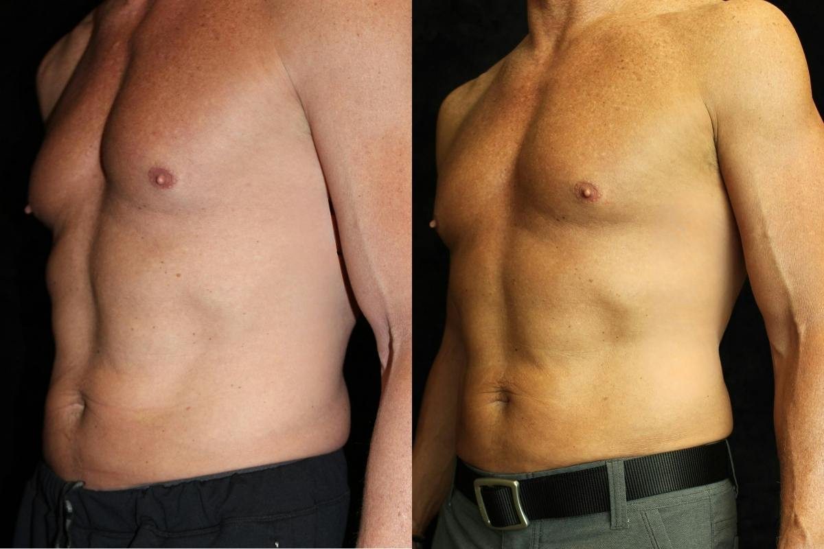 Male Body Contouring Before & After Gallery - Patient 761555 - Image 2