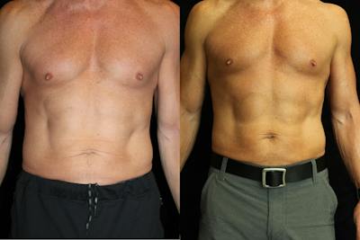 Male Body Contouring Before & After Gallery - Patient 761555 - Image 1