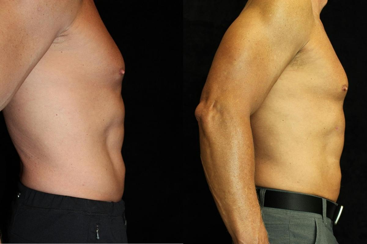 Male Body Contouring Before & After Gallery - Patient 761555 - Image 3