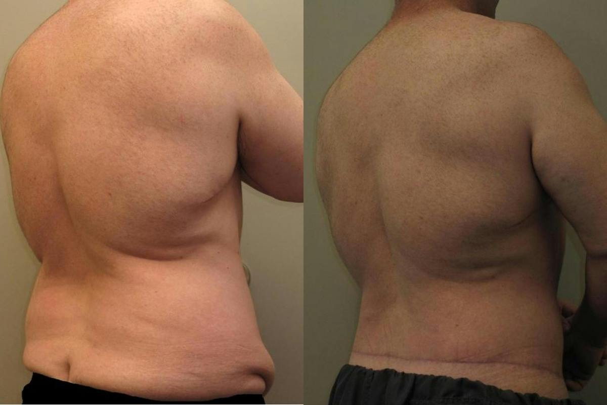 Male Body Contouring Before & After Gallery - Patient 200907 - Image 2