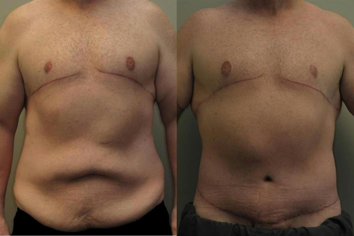 Male Body Contouring Before & After Gallery - Patient 200907 - Image 1