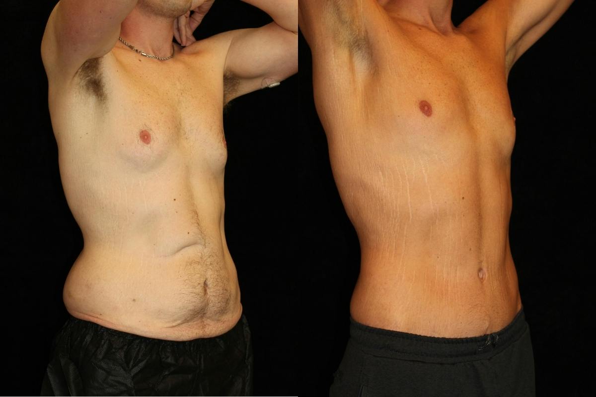 Male Body Contouring Before & After Gallery - Patient 333591 - Image 2