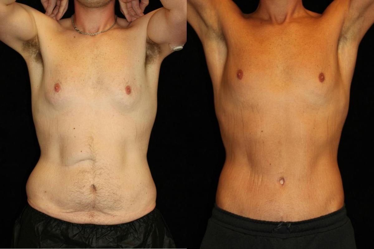 Male Body Contouring Before & After Gallery - Patient 333591 - Image 1