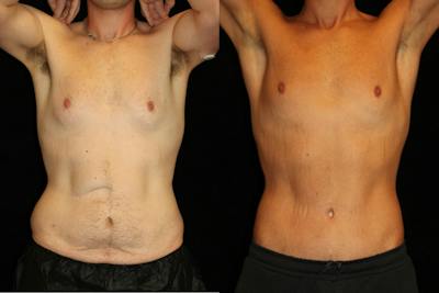 Male Body Contouring Before & After Gallery - Patient 333591 - Image 1