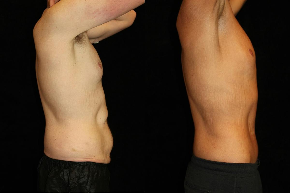 Male Body Contouring Before & After Gallery - Patient 333591 - Image 3