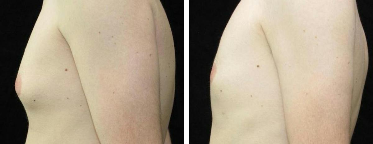 Male Breast Reduction Before & After Gallery - Patient 314746 - Image 2