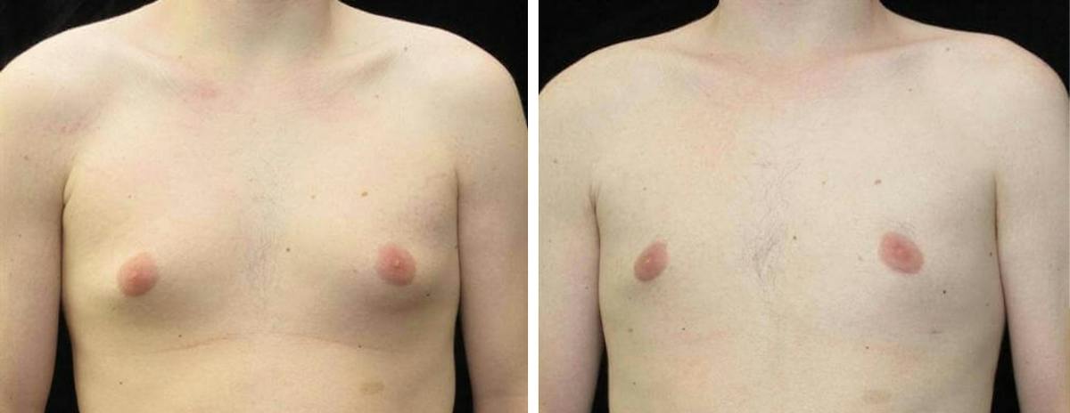 Male Breast Reduction Before & After Gallery - Patient 314746 - Image 1
