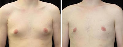 Male Breast Reduction Before & After Gallery - Patient 314746 - Image 1