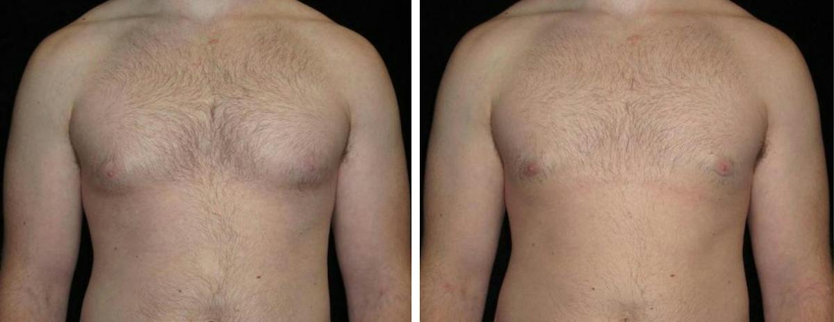 Male Breast Reduction Before & After Gallery - Patient 489984 - Image 1
