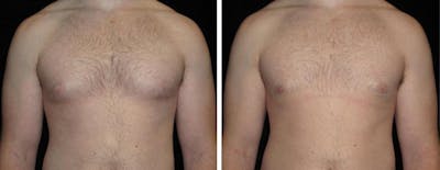 Male Breast Reduction Before & After Gallery - Patient 489984 - Image 1