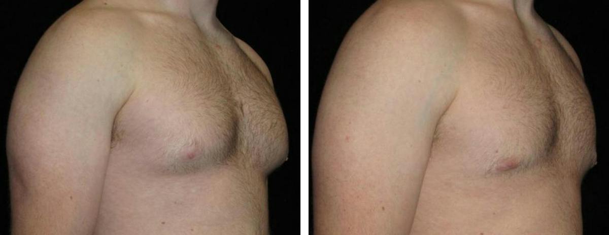 Male Breast Reduction Before & After Gallery - Patient 489984 - Image 2