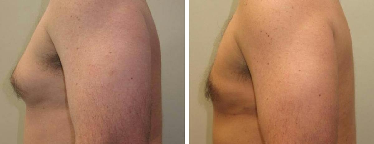 Male Breast Reduction Before & After Gallery - Patient 425272 - Image 3