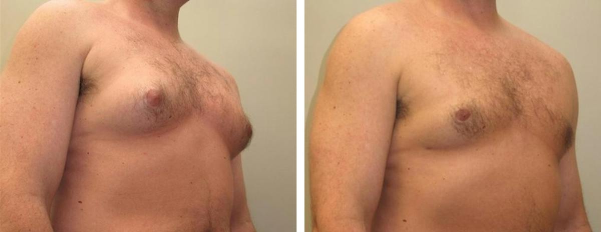 Male Breast Reduction Before & After Gallery - Patient 425272 - Image 2
