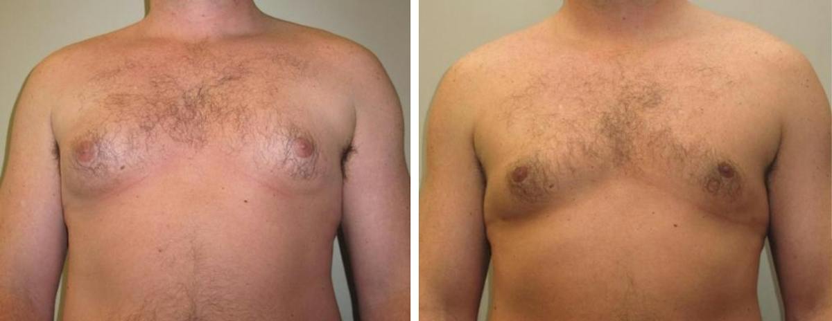 Male Breast Reduction Before & After Gallery - Patient 425272 - Image 1