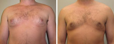 Male Breast Reduction Before & After Gallery - Patient 425272 - Image 1