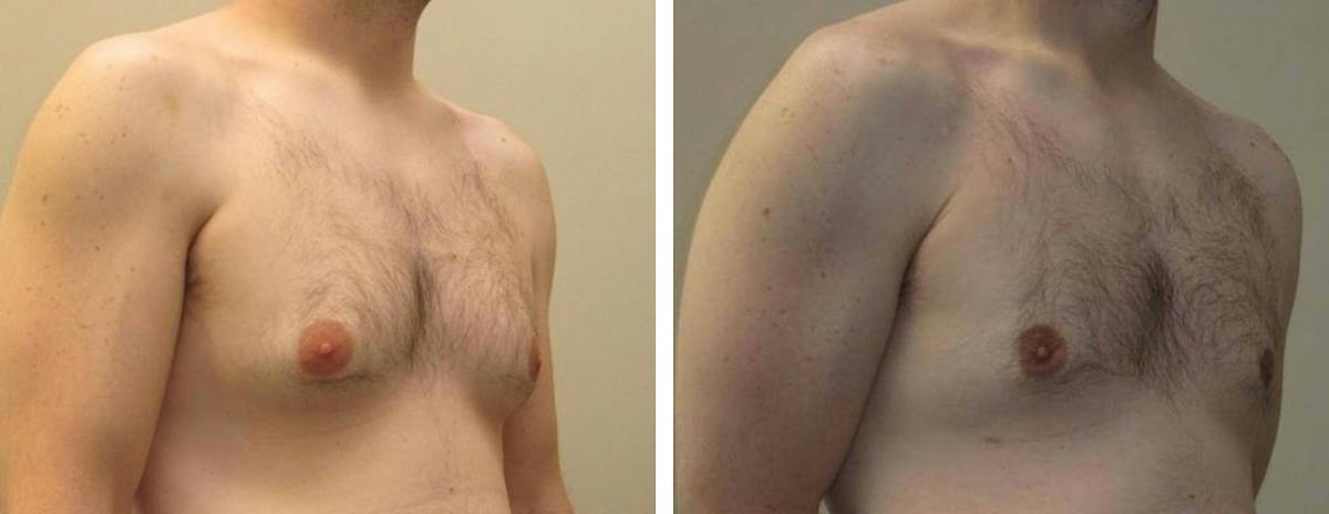 Male Breast Reduction Before & After Gallery - Patient 309402 - Image 2