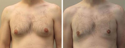 Male Breast Reduction Before & After Gallery - Patient 309402 - Image 1