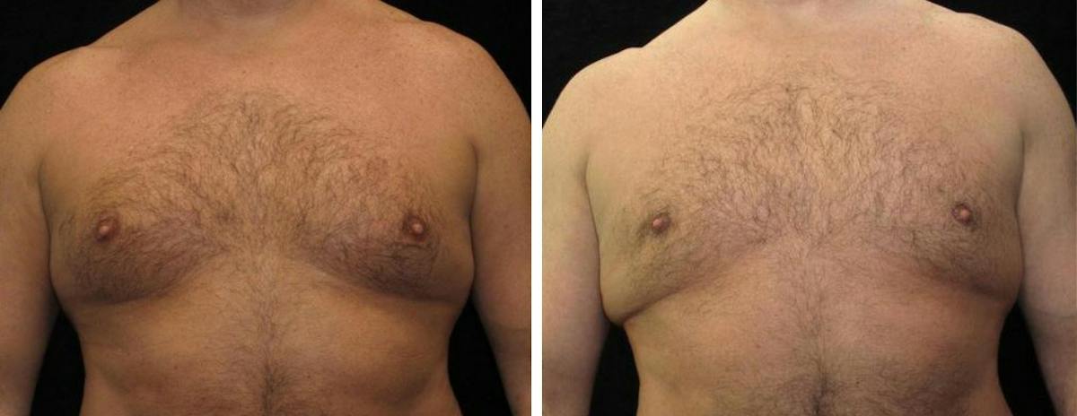 Male Breast Reduction Before & After Gallery - Patient 243987 - Image 1