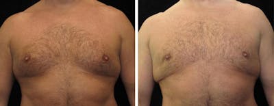 Male Breast Reduction Before & After Gallery - Patient 243987 - Image 1