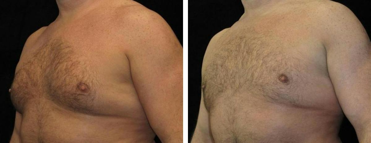 Male Breast Reduction Before & After Gallery - Patient 243987 - Image 2