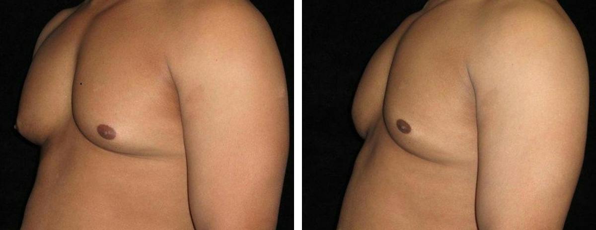 Male Breast Reduction Before & After Gallery - Patient 280091 - Image 2