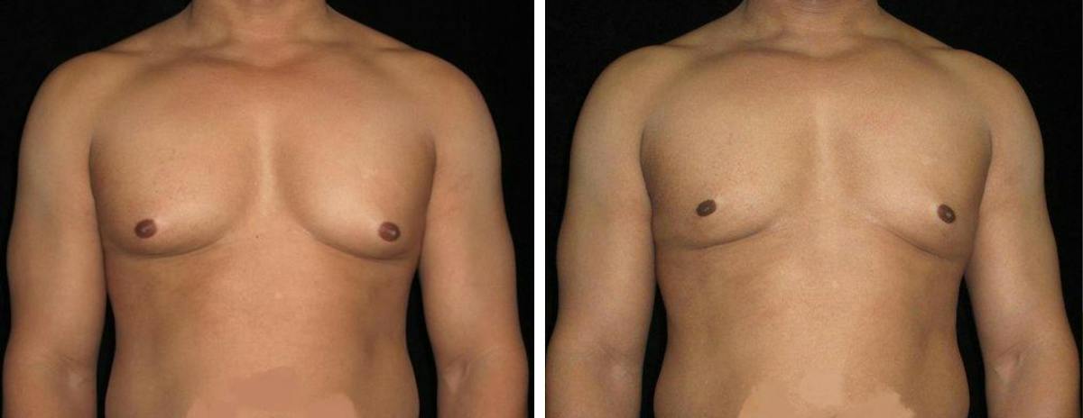 Male Breast Reduction Before & After Gallery - Patient 280091 - Image 1
