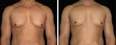 Male Breast Reduction Before & After Gallery - Patient 280091 - Image 1